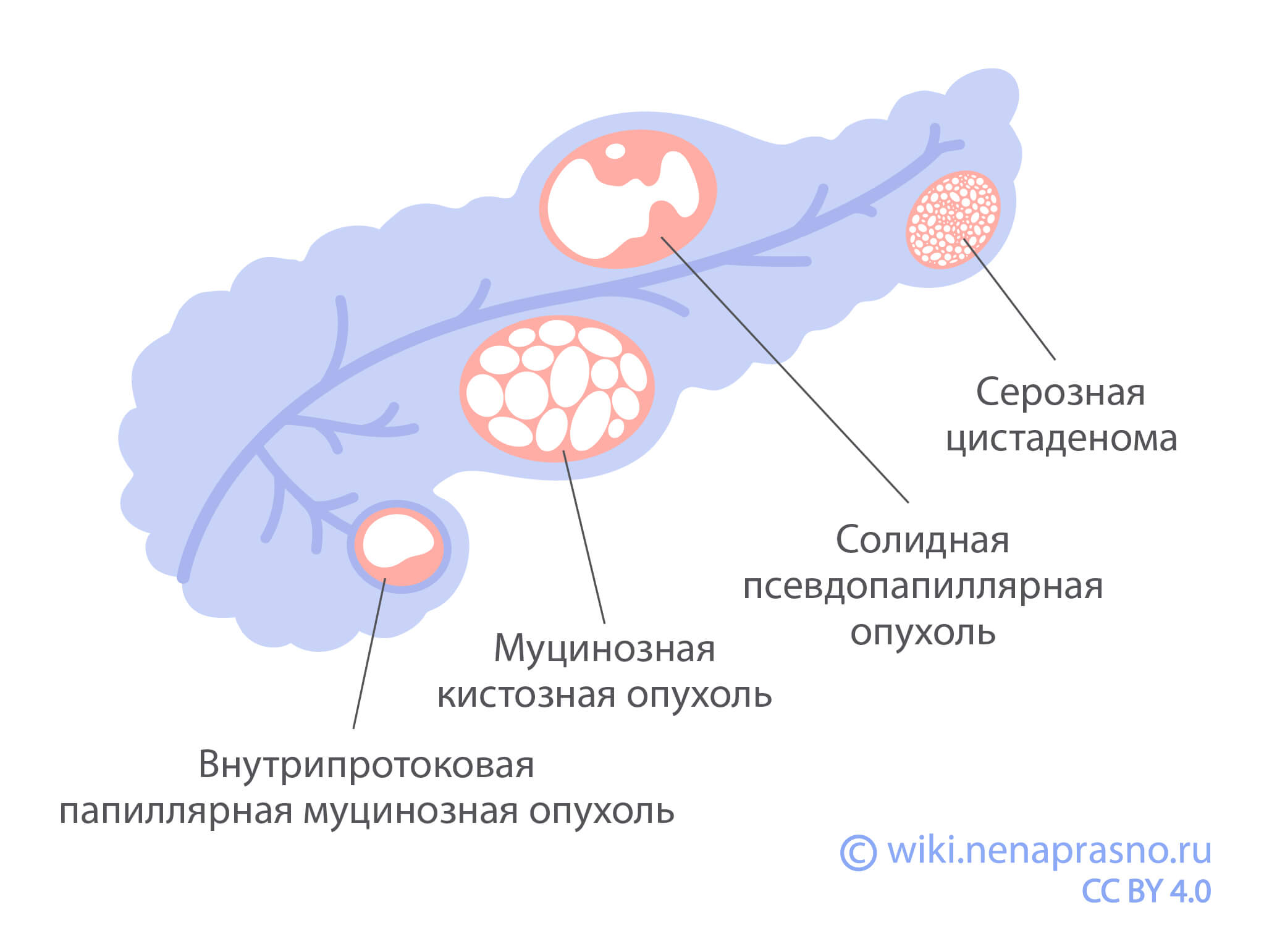 Кисты поджелудочной железы