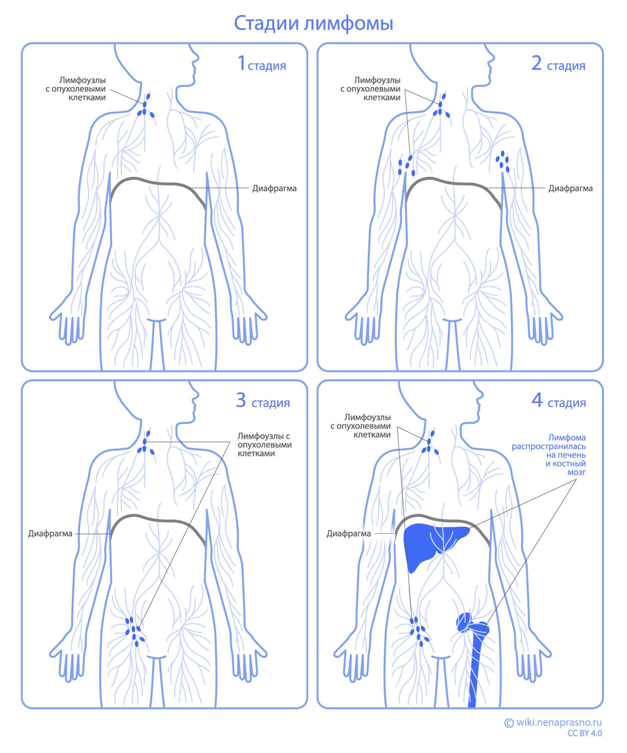 Стадии лимфомы.jpg