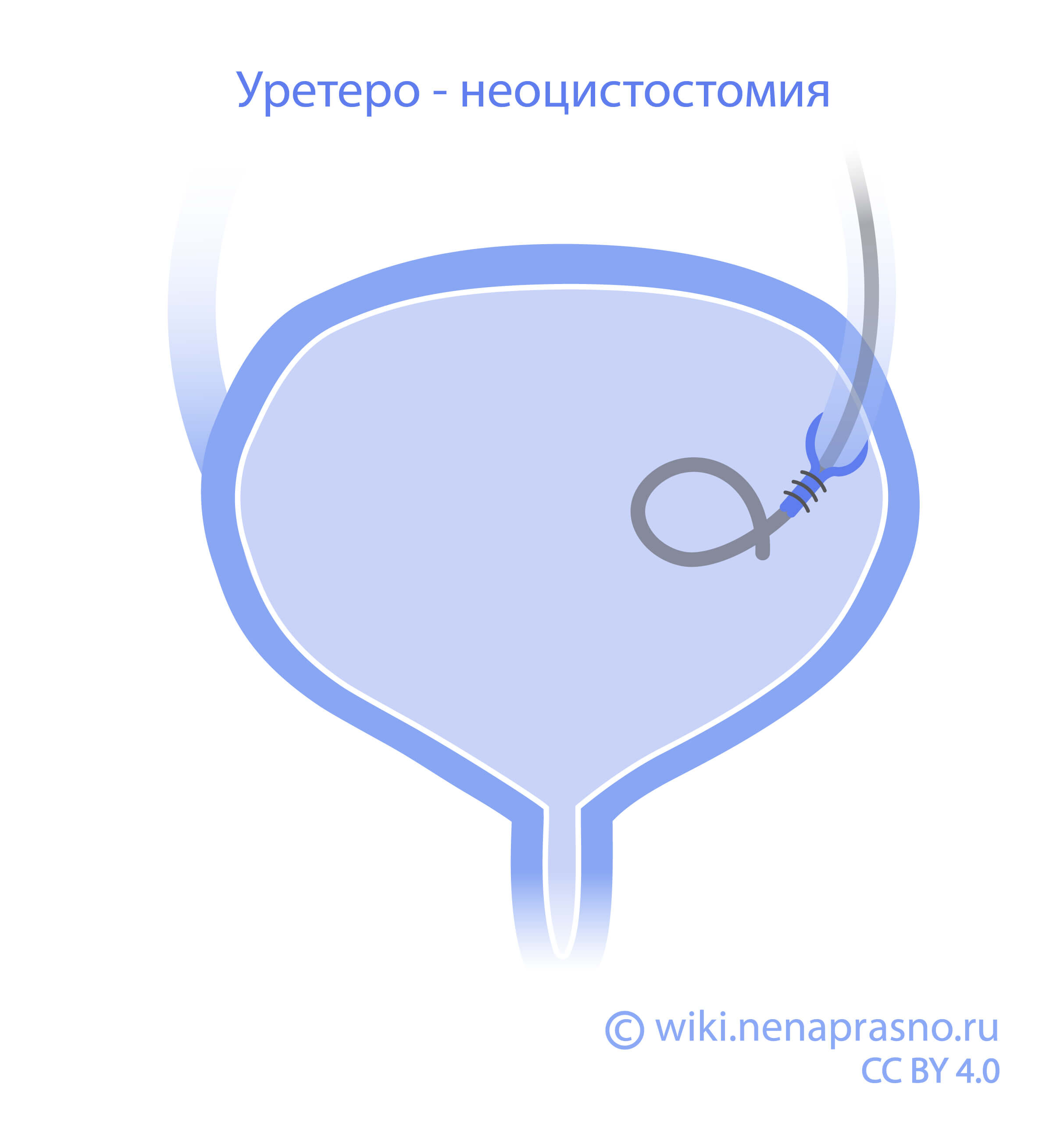 Уретеро-неоцистостомия.jpg Уретеро-неоцистостомия.jpg