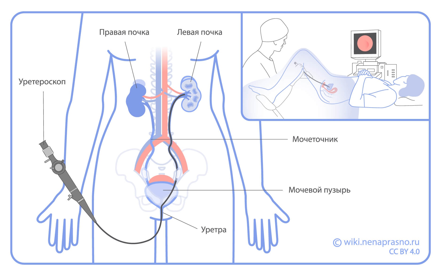 Уретероскоп.jpg Уретероскоп.jpg