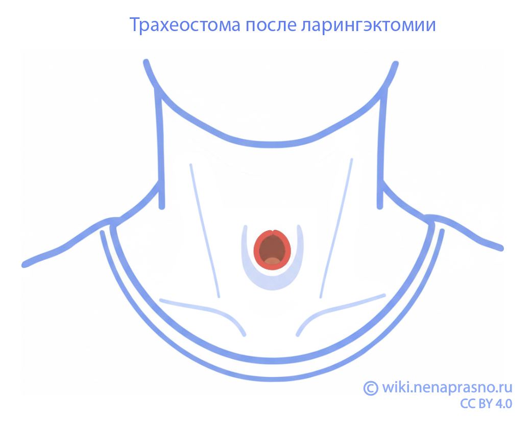 Трахеостома после ларингэктомии.jpg