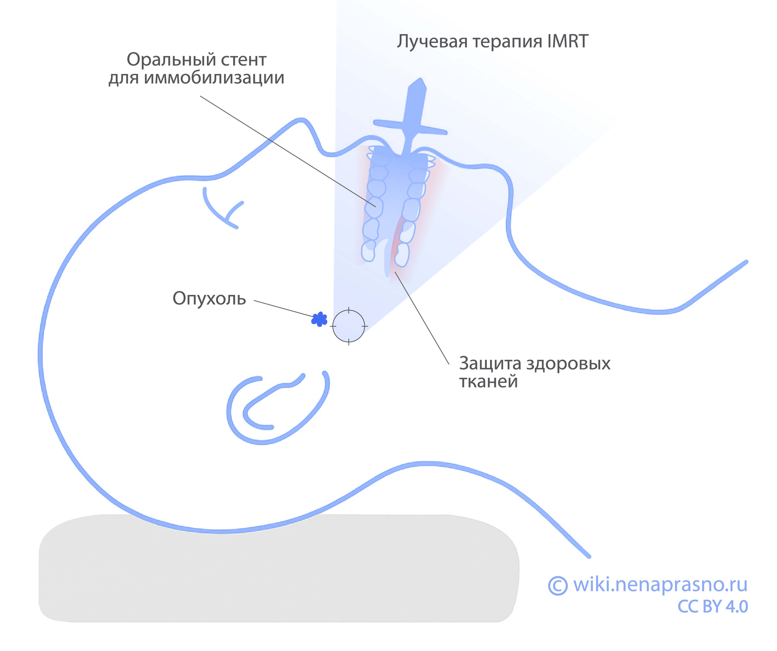 Luchevaya_terapia_IMRT.jpg Luchevaya_terapia_IMRT.jpg