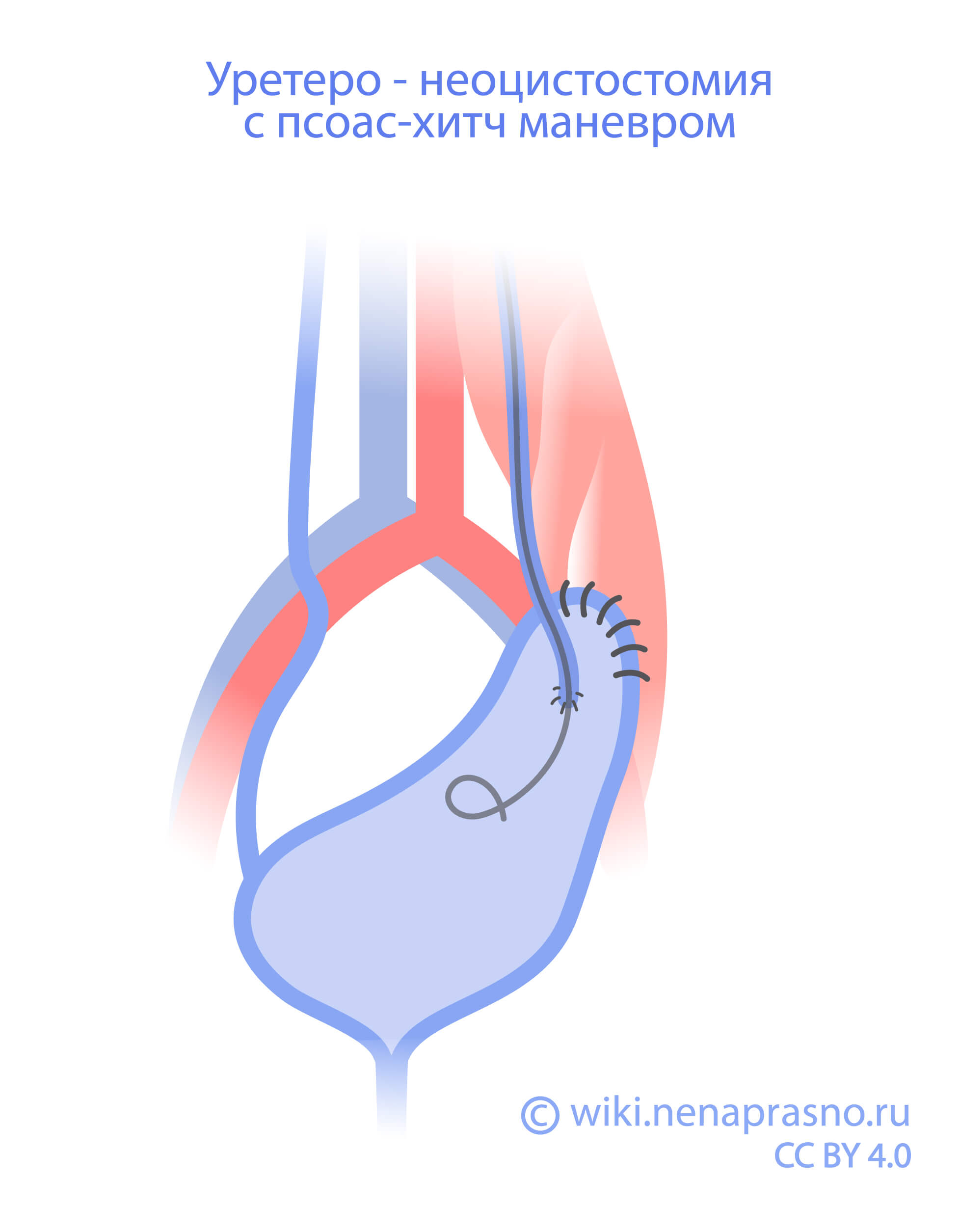 Уретеро-неоцистостомия с псоас-хитч маневром.jpg Уретеро-неоцистостомия с псоас-хитч маневром.jpg