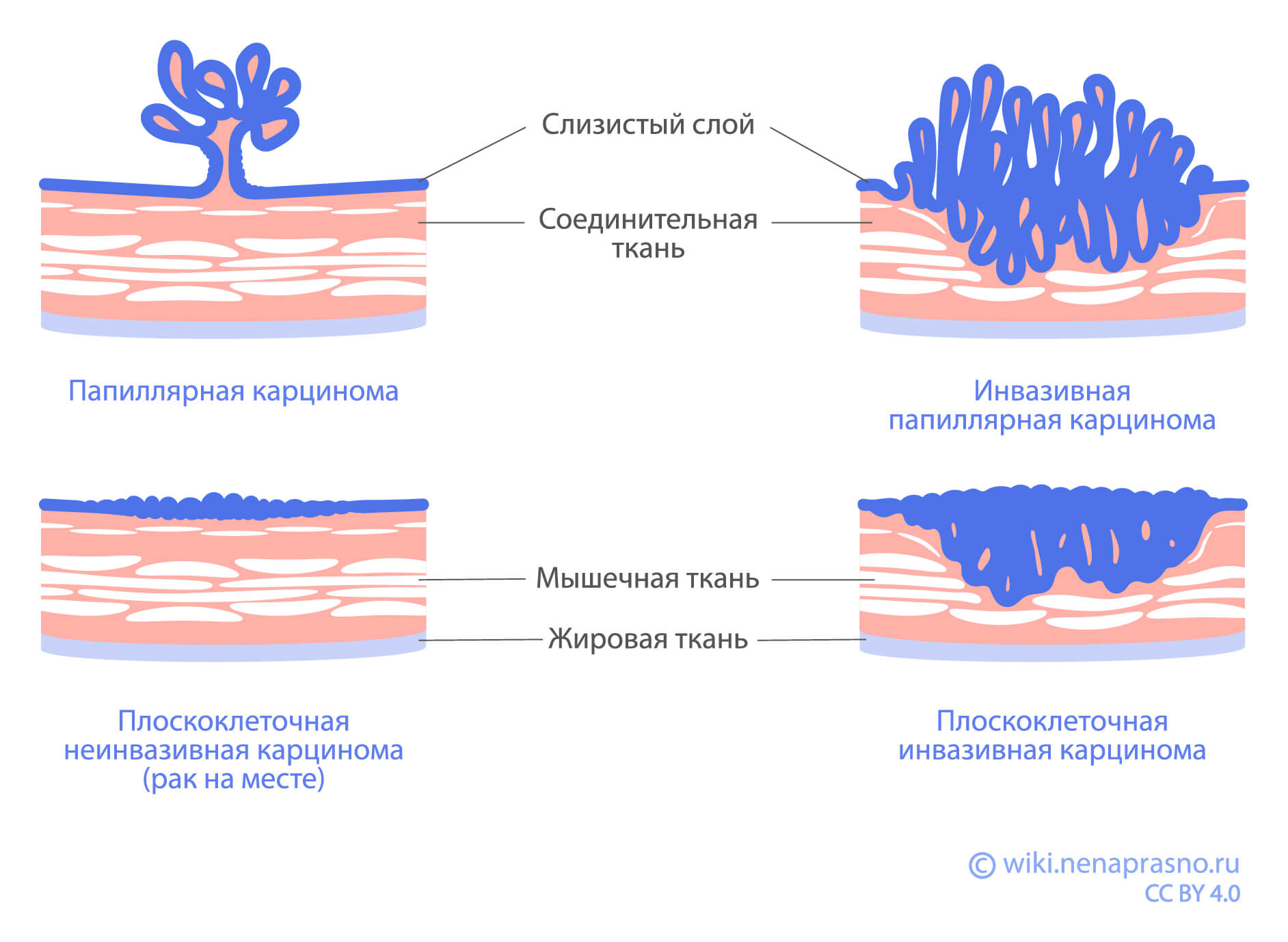 Карцинома.jpg Карцинома.jpg
