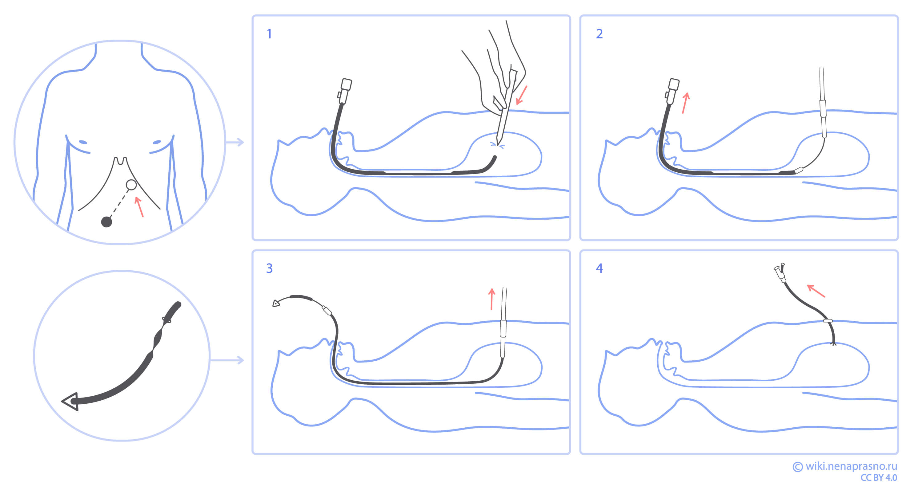 Зонд при гастростоме.jpg Зонд при гастростоме.jpg