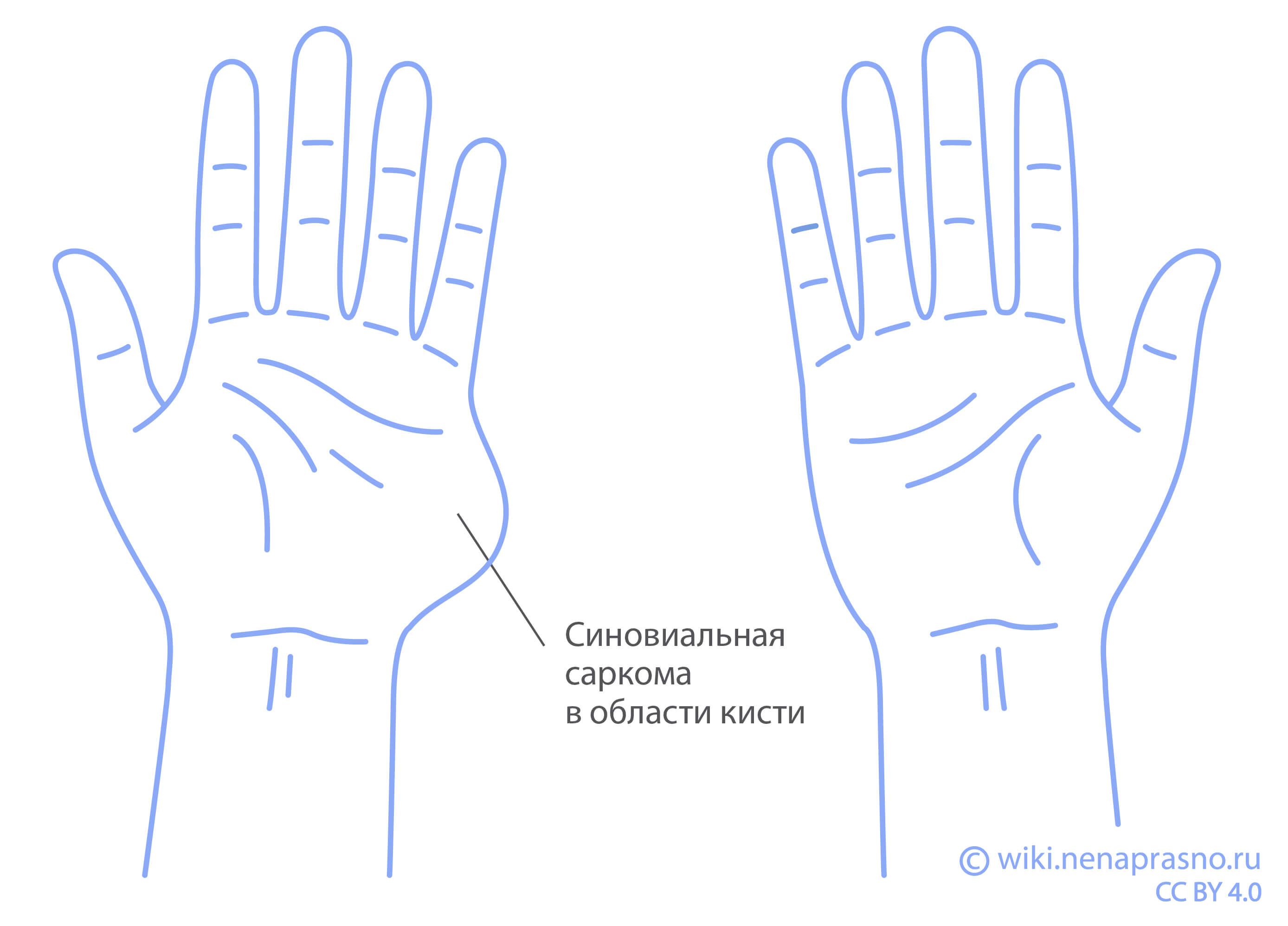 Синовиальная саркома.jpg