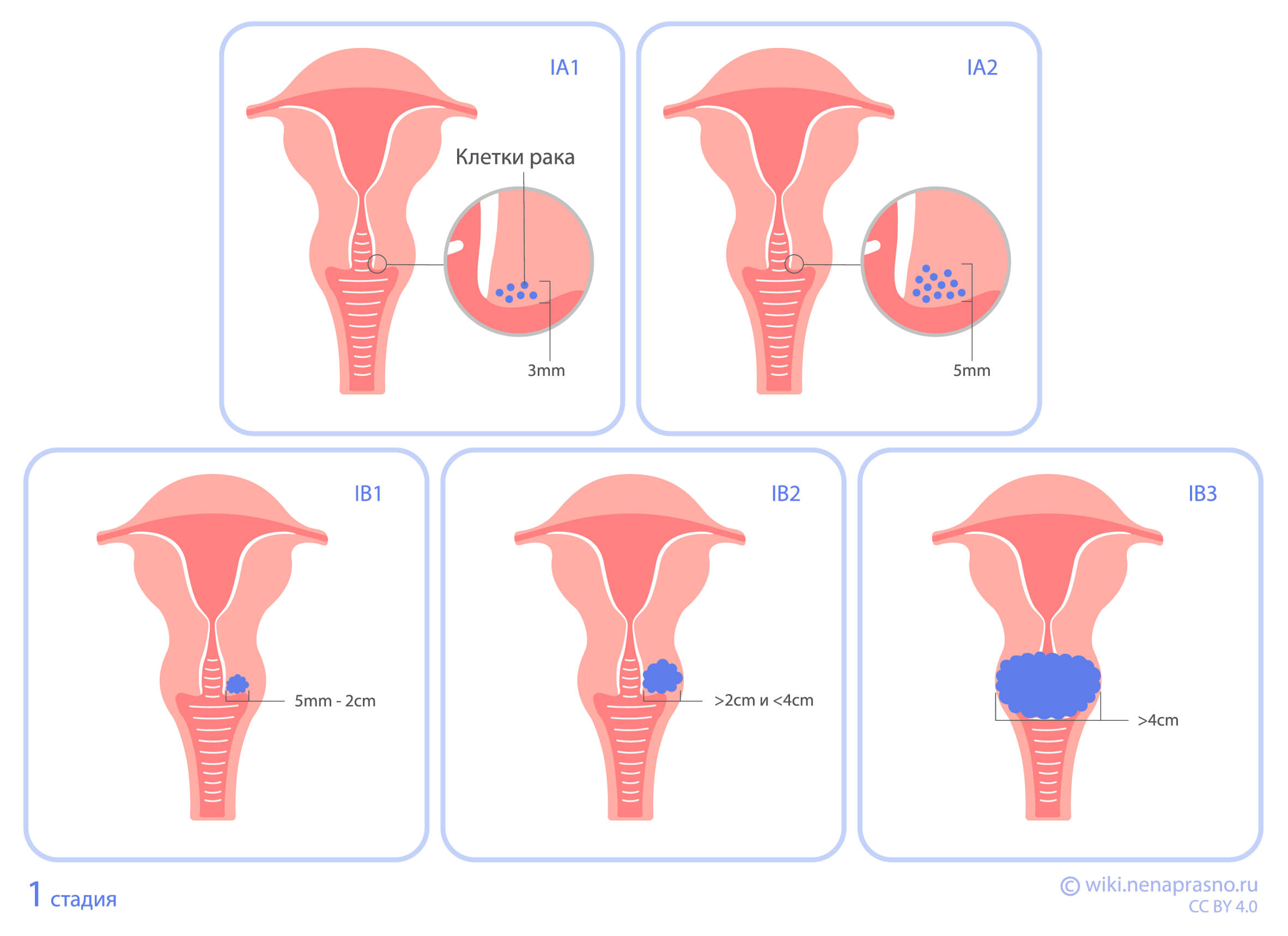 Стадии рака шейки матки