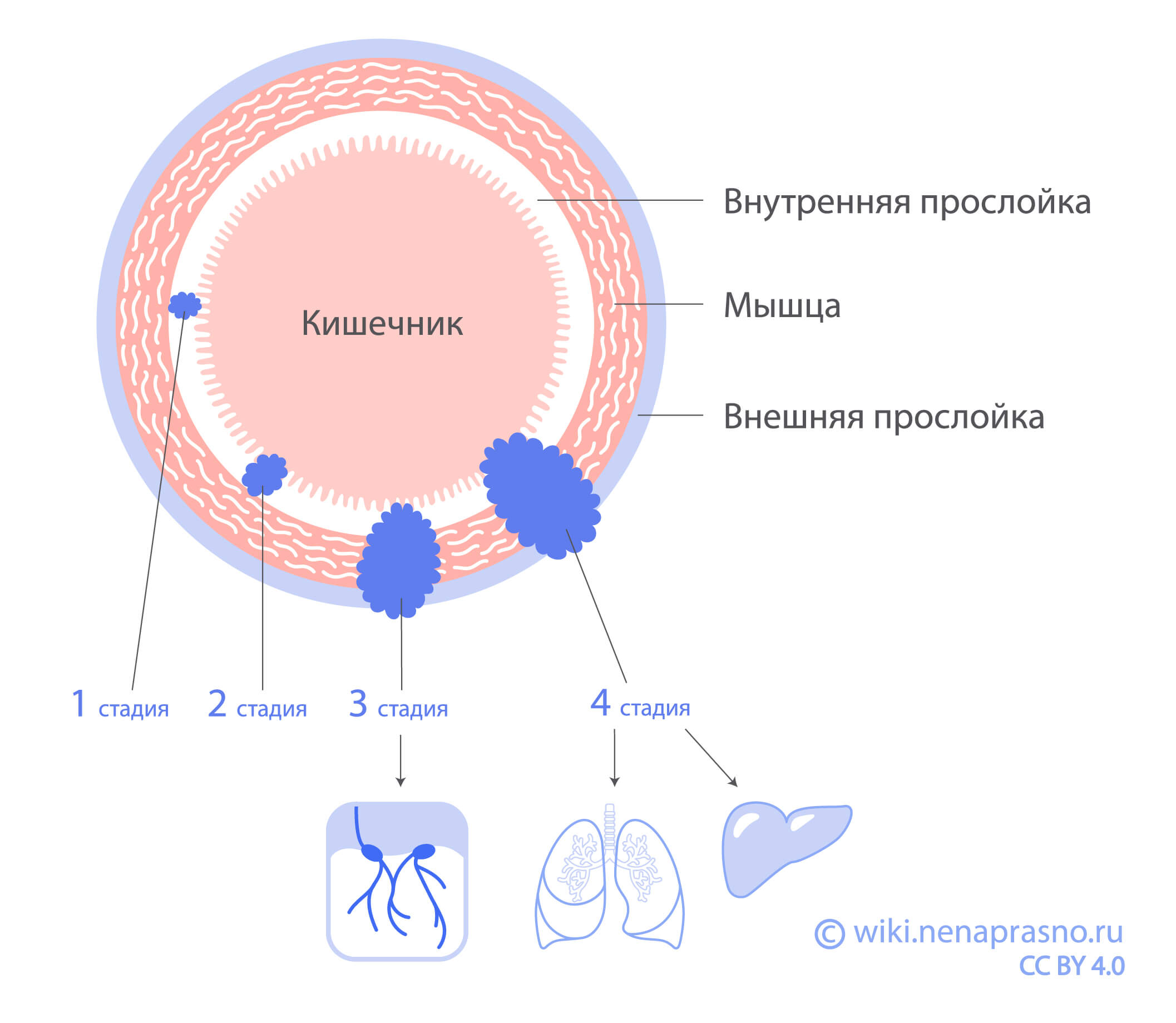 Стадии колоректального рака