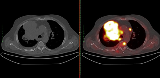 Свечение опухоли на ПЭТ/КТ