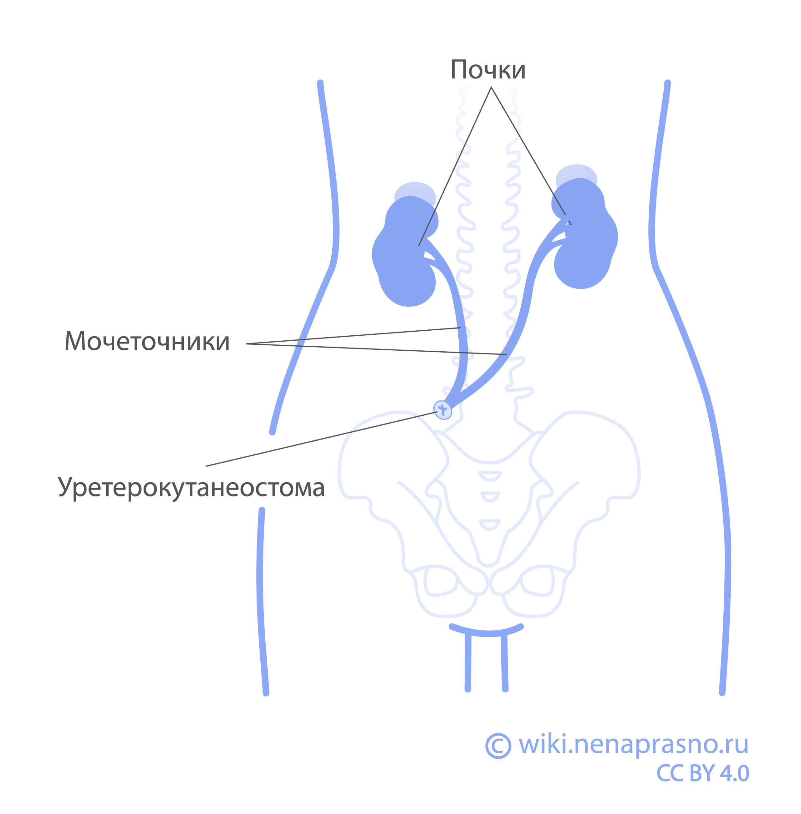 Уретерокутанеостома.jpg Уретерокутанеостома.jpg