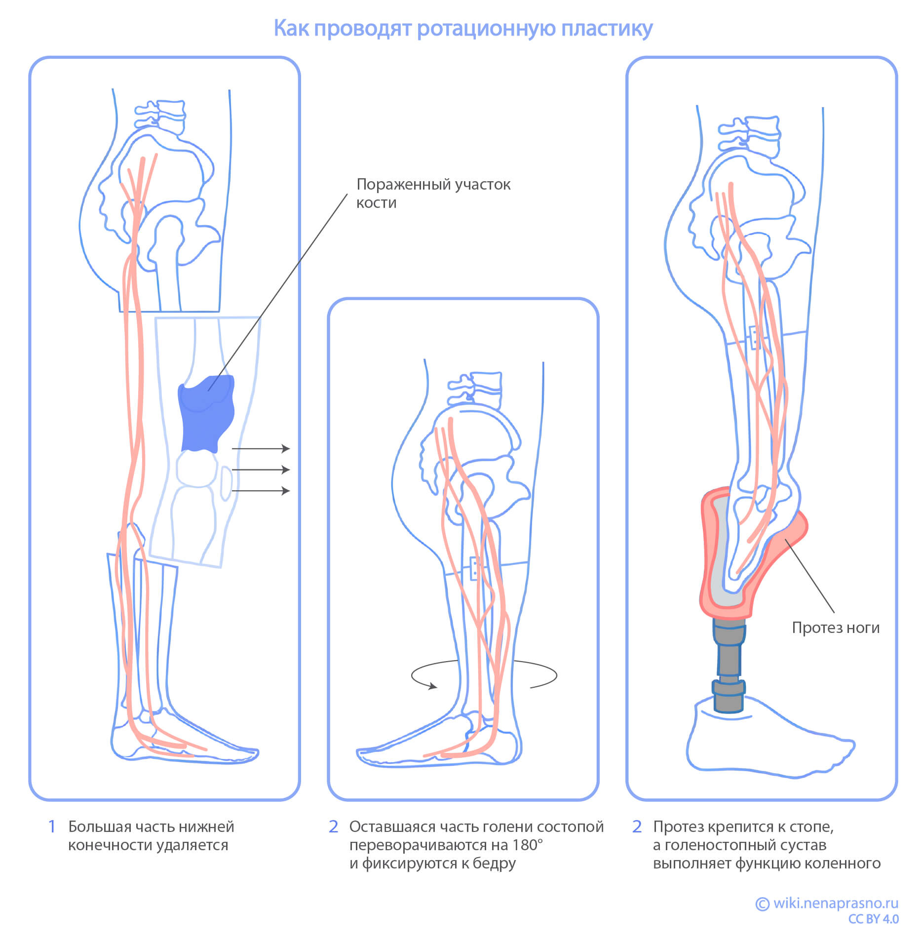 Ротационная пластика.jpg