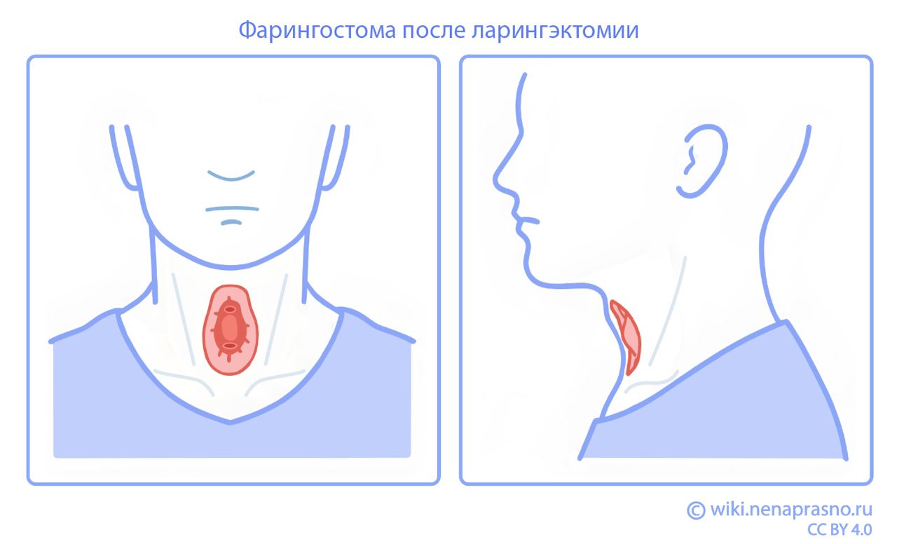 Фарингостома после ларингэктомии.jpg