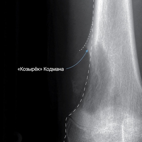 Козырек Кодмана.jpg
