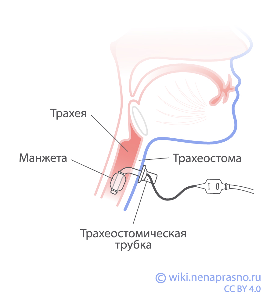 Трахеостома.jpg Трахеостома.jpg
