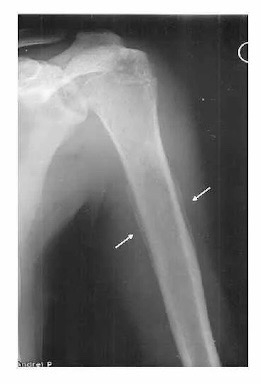 Луковичный периостит саркома Юинга .jpg