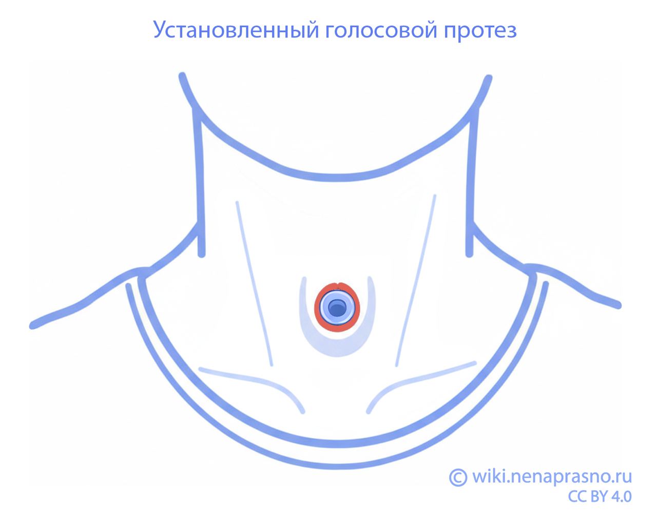 Установленный голосовой протез.jpg